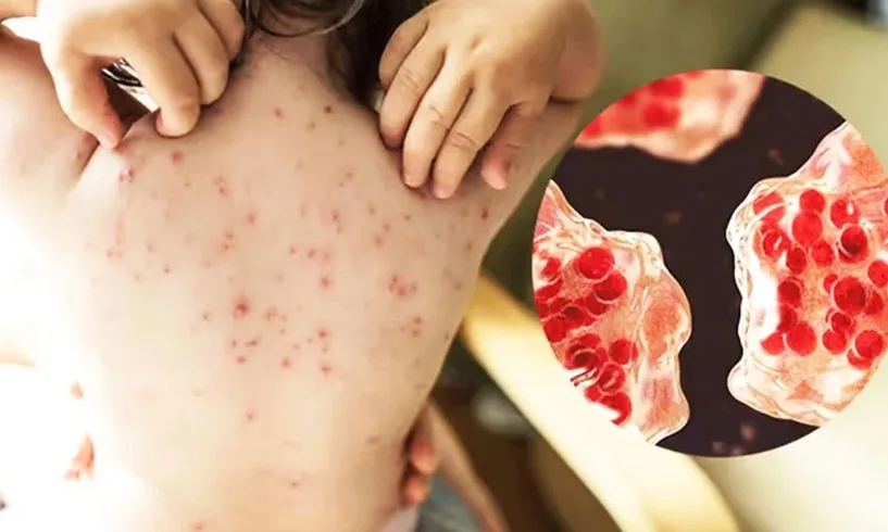 হামের তাণ্ডবে ৫৬ জেলায় হাহাকার